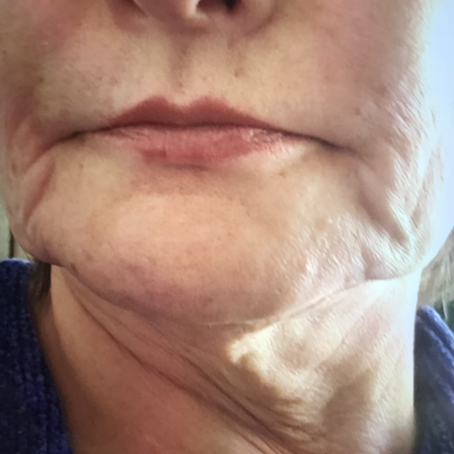 Waterman Mini-lift || Before & After ||  -F34. 