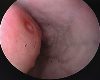 spirocerca lupi