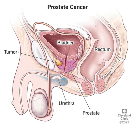 From Awareness to Action: Understanding Prostate Cancer
