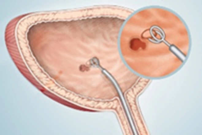 Cystoscopy with Biopsy (McMillen, 2025)