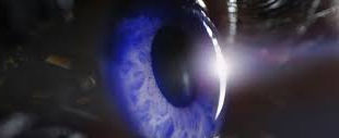 Posterior Capsulotomy (YAG Laser)