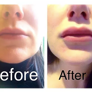Lip Enhancement with Dr Sotirios Foutsizoglou