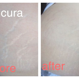 Salcura Stretch Mark Range