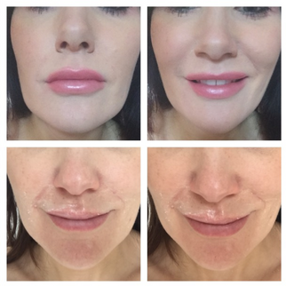 Lips, Chin & fine perioral lines by Visage