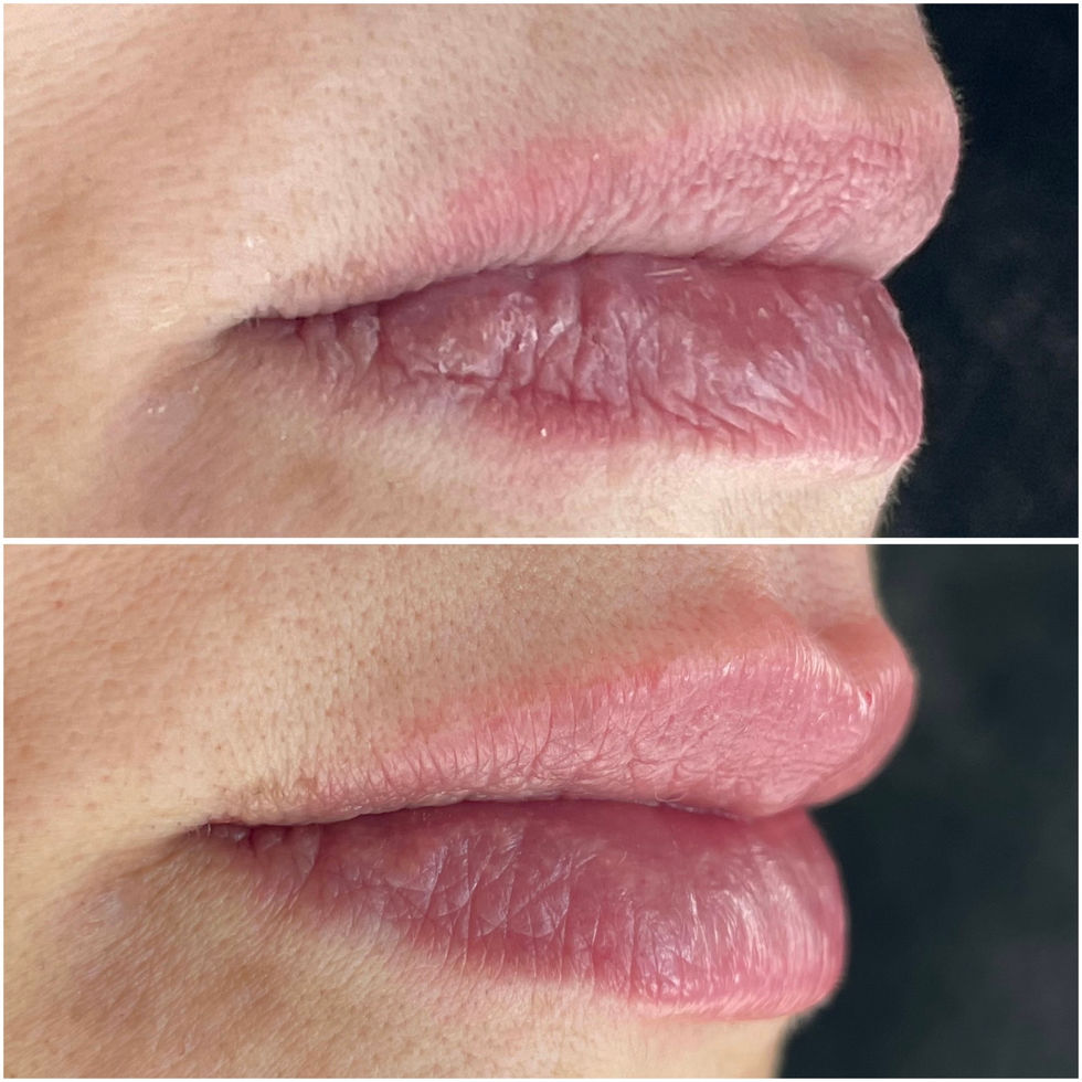 labio 