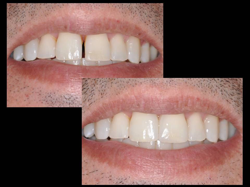 resina fechamento de diastema