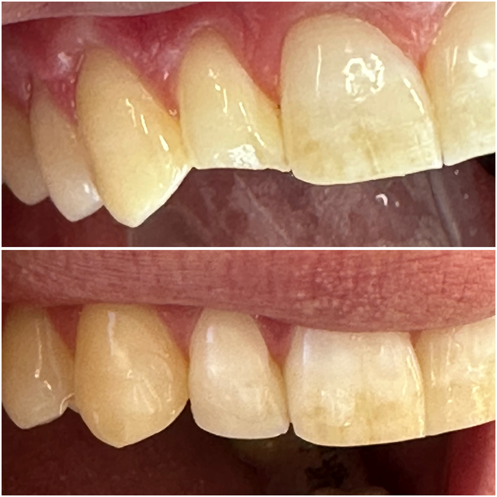 1 dente quebrado 