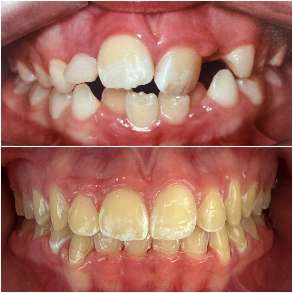 20 meses de tratamento 