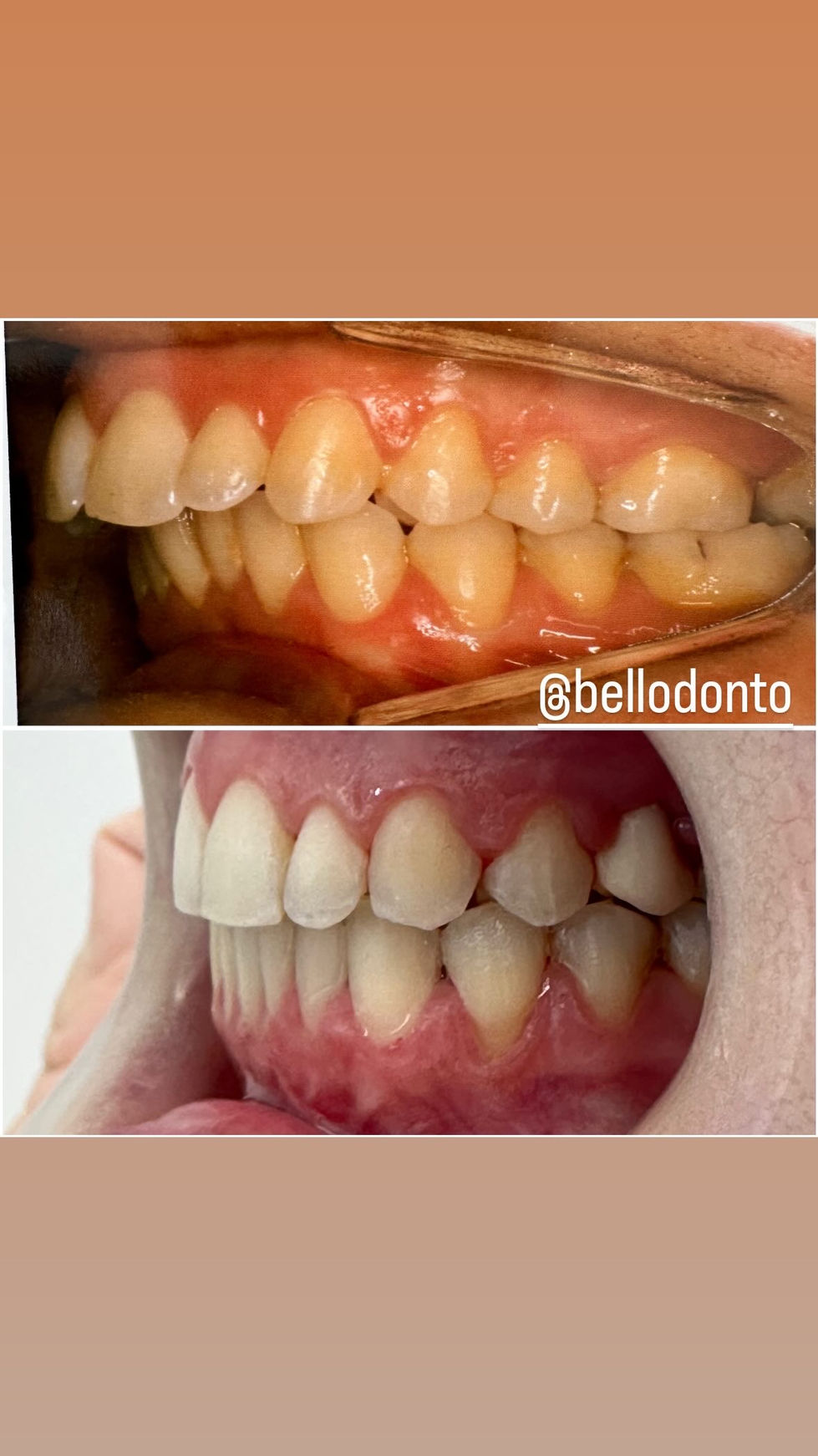 12 meses de tratamento 