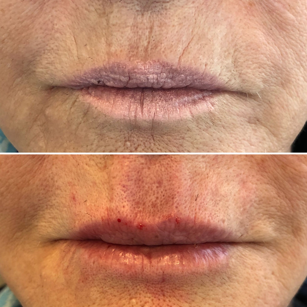 labio e rugas