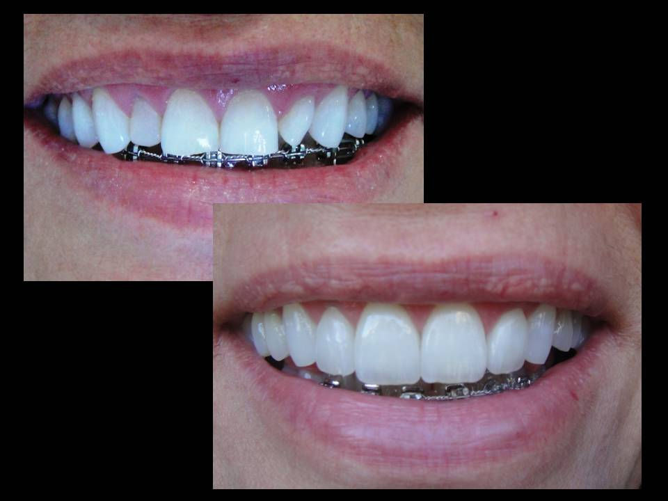 4 dentes em cerâmica