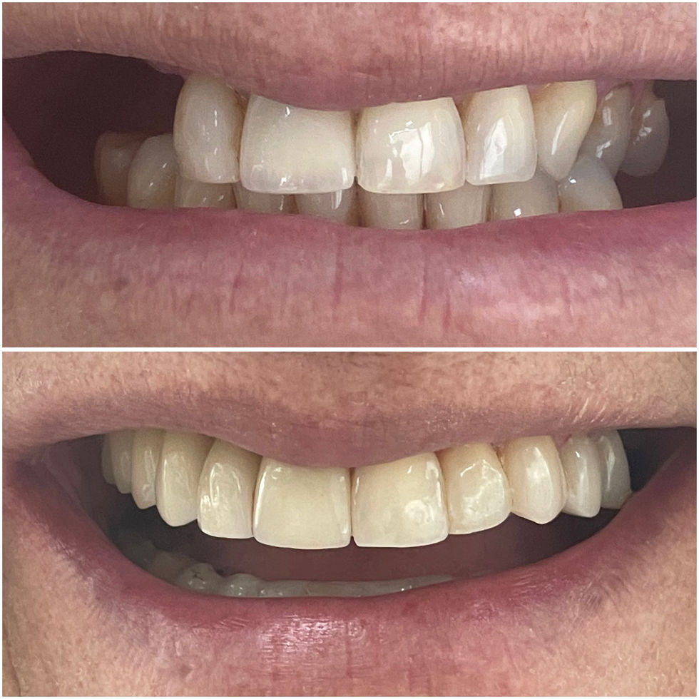próteses sobre dentes e sobre implantes