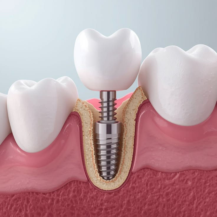 Dental implant uygulaması ile doğal ve estetik gülüş planlaması – Funda Sarıkaya Diş Polikliniği