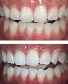 Before and after of teeth. Top row: good teeth. Bottom row: crooked teeth, whiter results after teeth whitening 