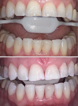 Teeth whitening before and after, showing results with bright, white smile