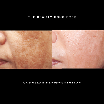 Cosmelan Depigmentation.png