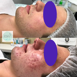 Acne Client Male1