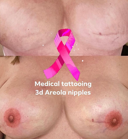 Areola Paramedical Tattoo in Torrance