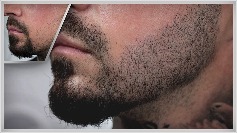 Beard-micropigmentation