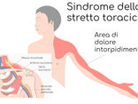Sindrome dello Stretto Toracico