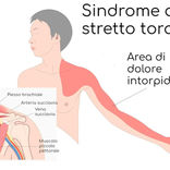 Sindrome dello Stretto Toracico