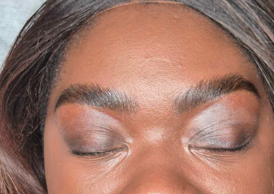Brow Lift