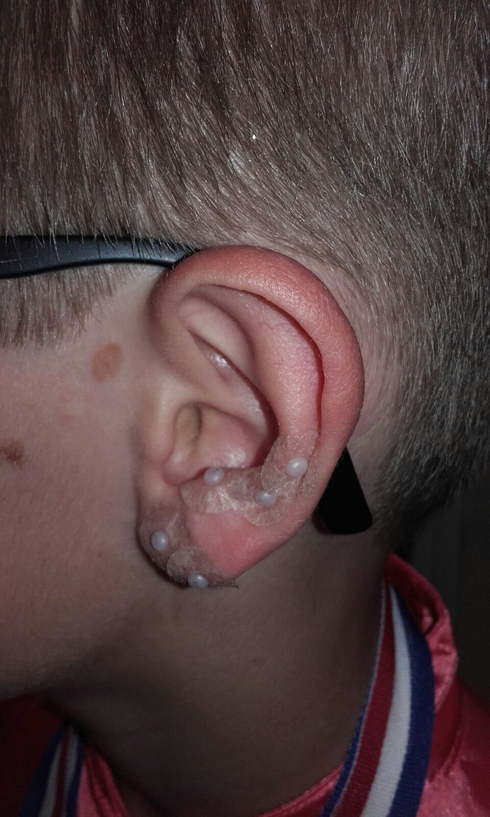 Acupuncture et auriculothérapie sans douleur pour les enfants par le Pôle de Thérapeutes