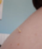 Exemple d'utilisation de petit cône d'armoise "grain de riz de l'Okyu à la place d'une aiguille d'acupuncture.