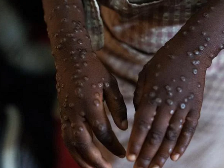 Sem vacinas, África tem quase 4 mil novos casos de mpox em uma semana