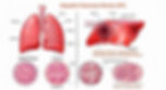Medical illustration comparing healthy lungs and alveoli with those damaged by Idiopathic Pulmonary Fibrosis (IPF), highlighting severe tissue scarring and thickened alveolar walls.