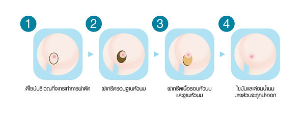 การลดขนาดหน้าอกโดยมีแผลรอบปานนม