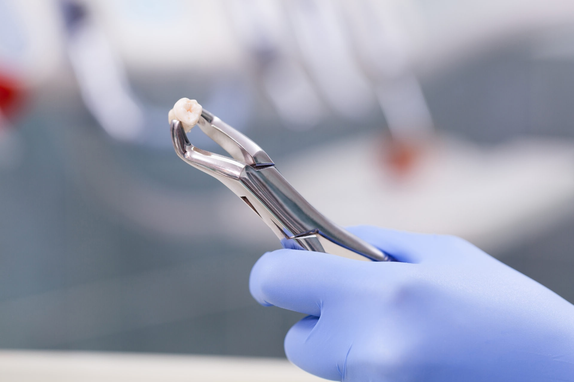 Pre Tooth Extraction Tooth Extraction