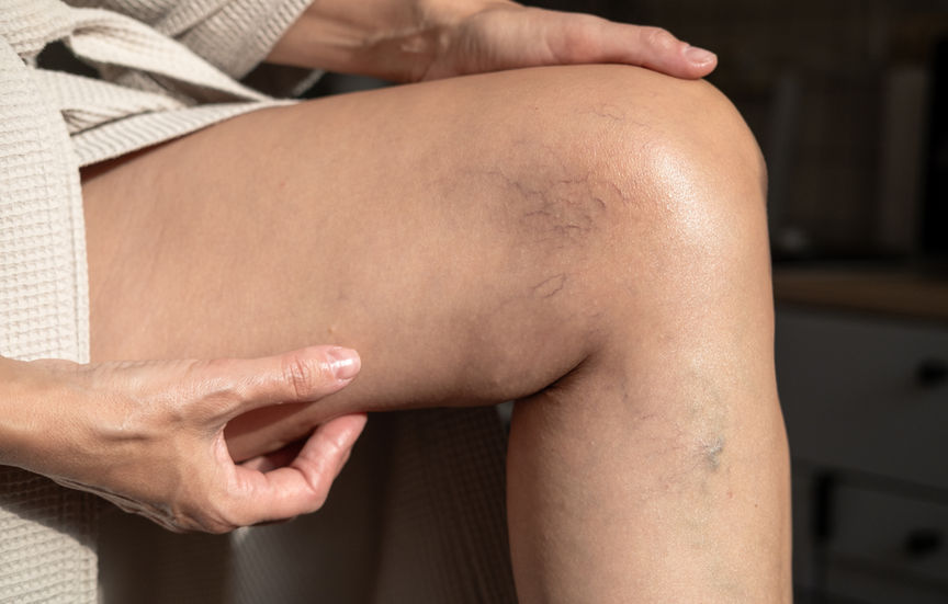 spider veins: medical definition and clinical overview