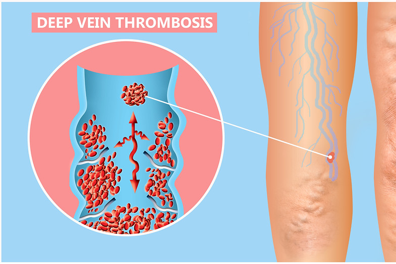 when to seek DVT treatment in Holland.jpg