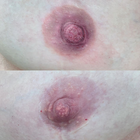 Unilateral Areola Tattoos in Charlotte, North Carolina
