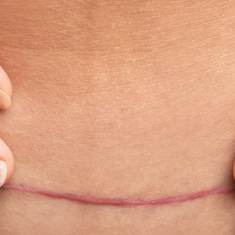 The Positive & Negative types of Friction on a Healing Scar