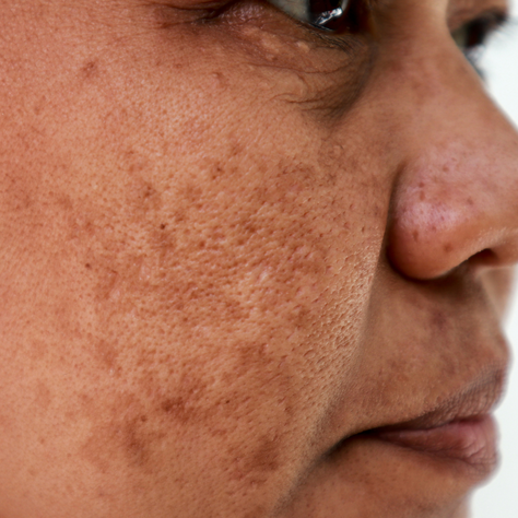 Melasma and Camouflage tattoo pigments 