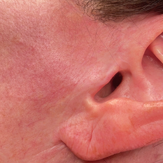 Facelift Scar Camouflage Tattoo in Charlotte, NC