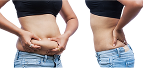 laser lipo before and after