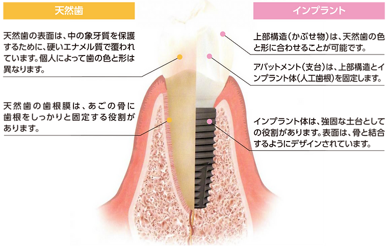 天然歯とインプラント.png