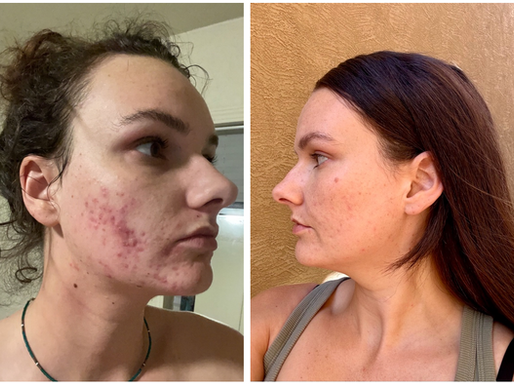 My Hormonal Cystic Acne Journey