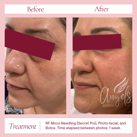 rf microneedling before and after morpheus 8 secret pro