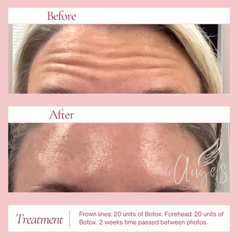 20 units botox forehead frown lines before and after