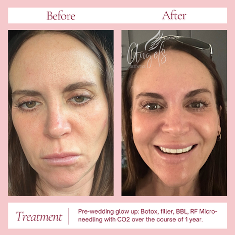 glow up before and after botox filler microneedling co2 best mclean virginia