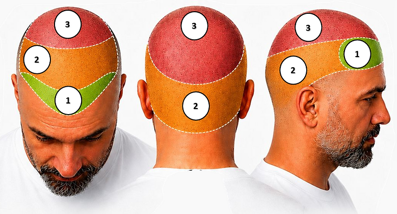 Haarpigmentierung, Scalp Micro Pigmentation, SMP, Bartpigmentierung, Tonsur
