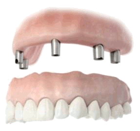 Conus-overdenture.gif