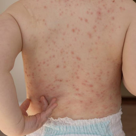 Daar is ‘n toename in maselsgevalle