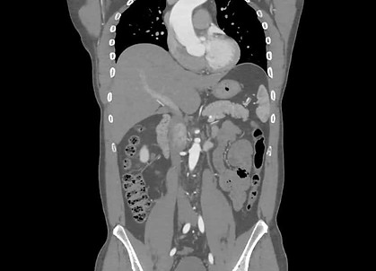 Whole_Body_CT_Scan.jpg
