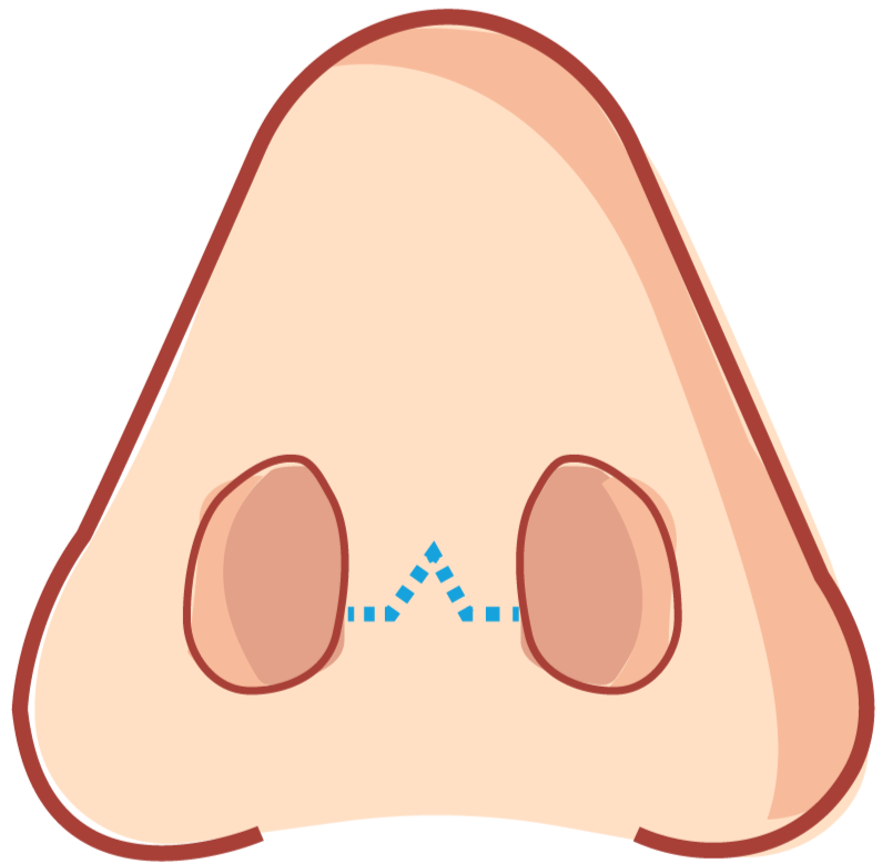 best septorhinoplasty complete guide