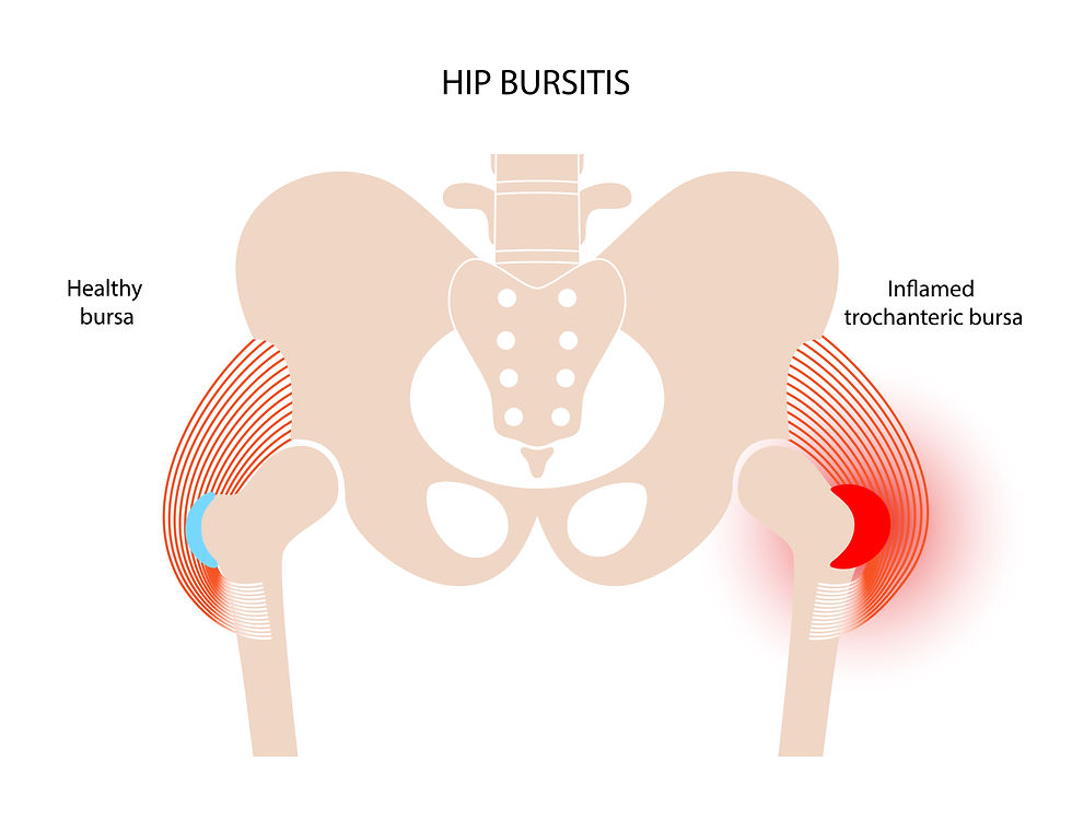 Comparative anatomy of hip bursitis, showcasing normal and affected bursae